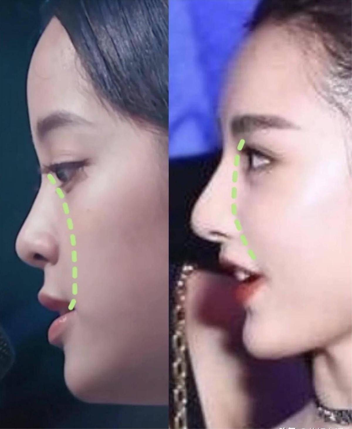 凸嘴,短下巴,塌鼻梁,面中凹陷,这些女明星的侧脸也太真实了