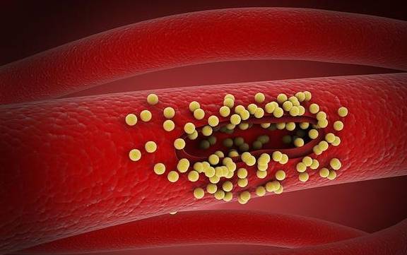 血管堵塞,很多健康問題或上門,對血管無益的壞習慣要儘早改掉_生活