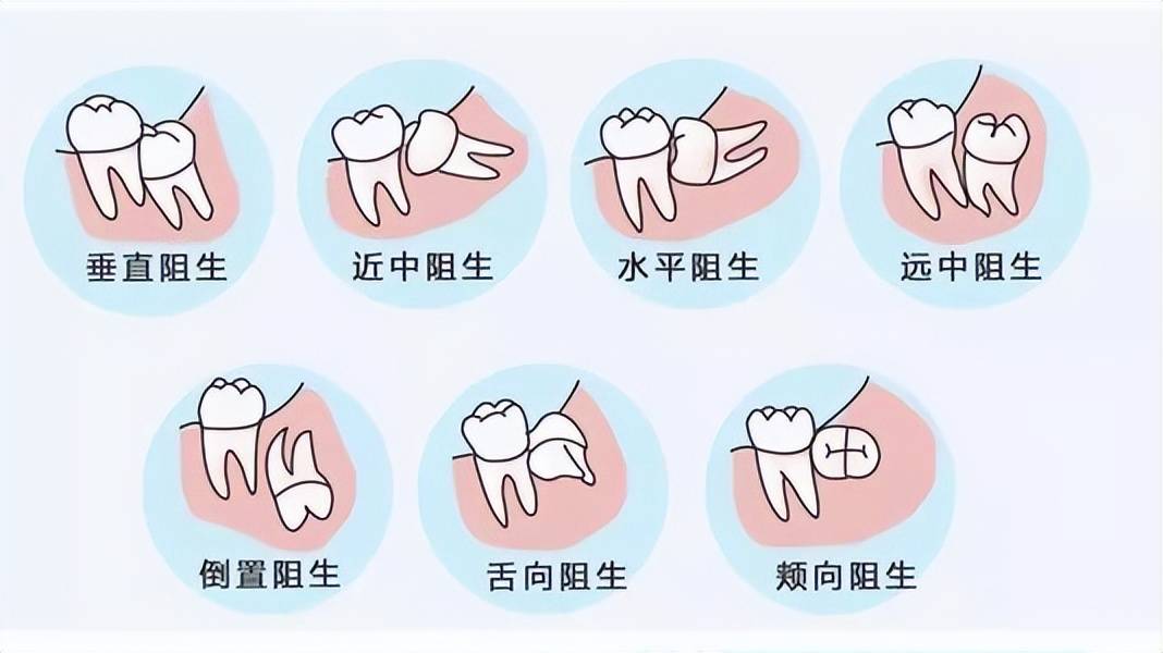 智齿有必要拔吗?拔智齿注意事项_牙齿_人类_牙龈