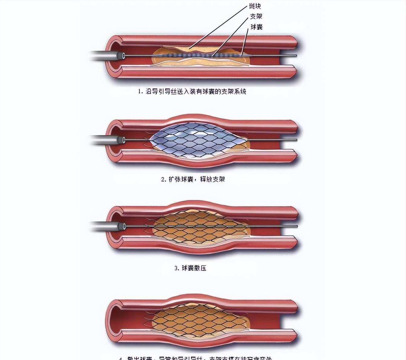 血管支架一个多少钱图片