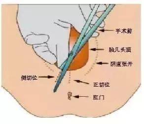 孕妇顺产阴壁膨出图片图片