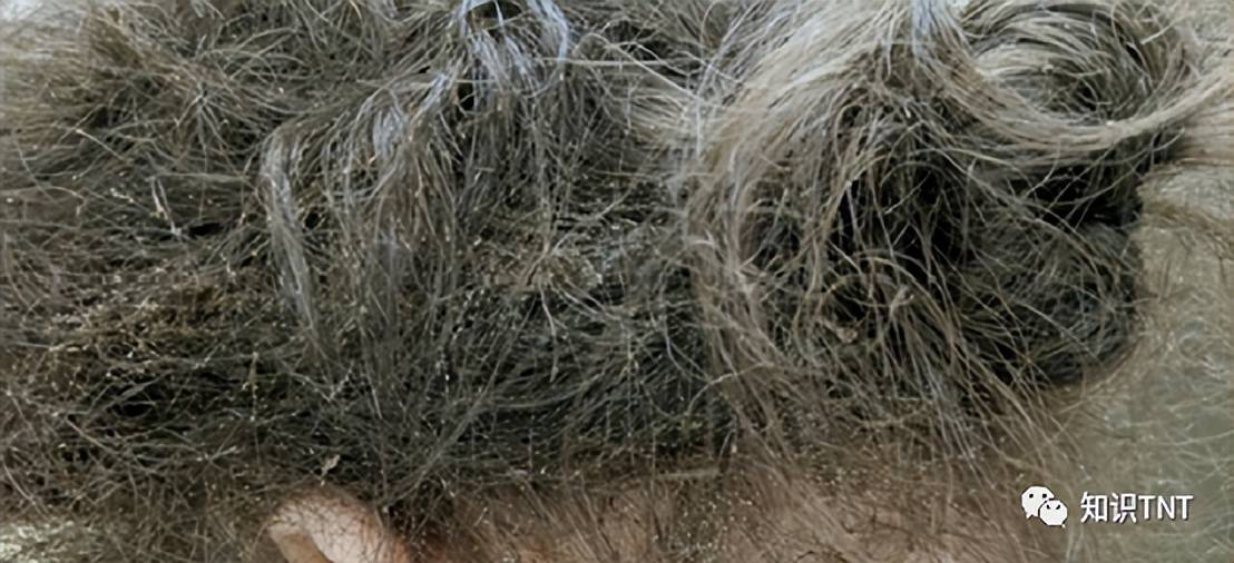 67头虱有多可怕?