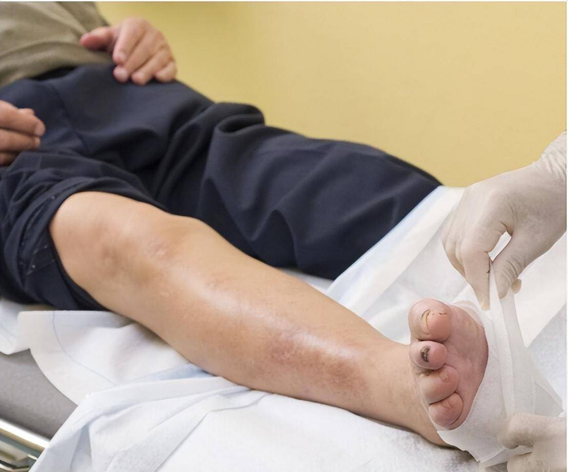 患者往往存在一定程度的感染,与草薛渗湿汤或四妙勇安汤口服清热朗