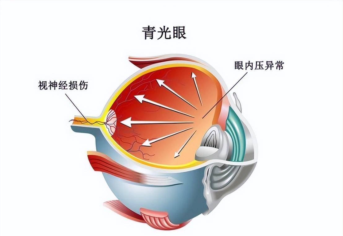 不可逆致盲性眼病青光眼,西医治疗临床应用手术有哪些优缺点?