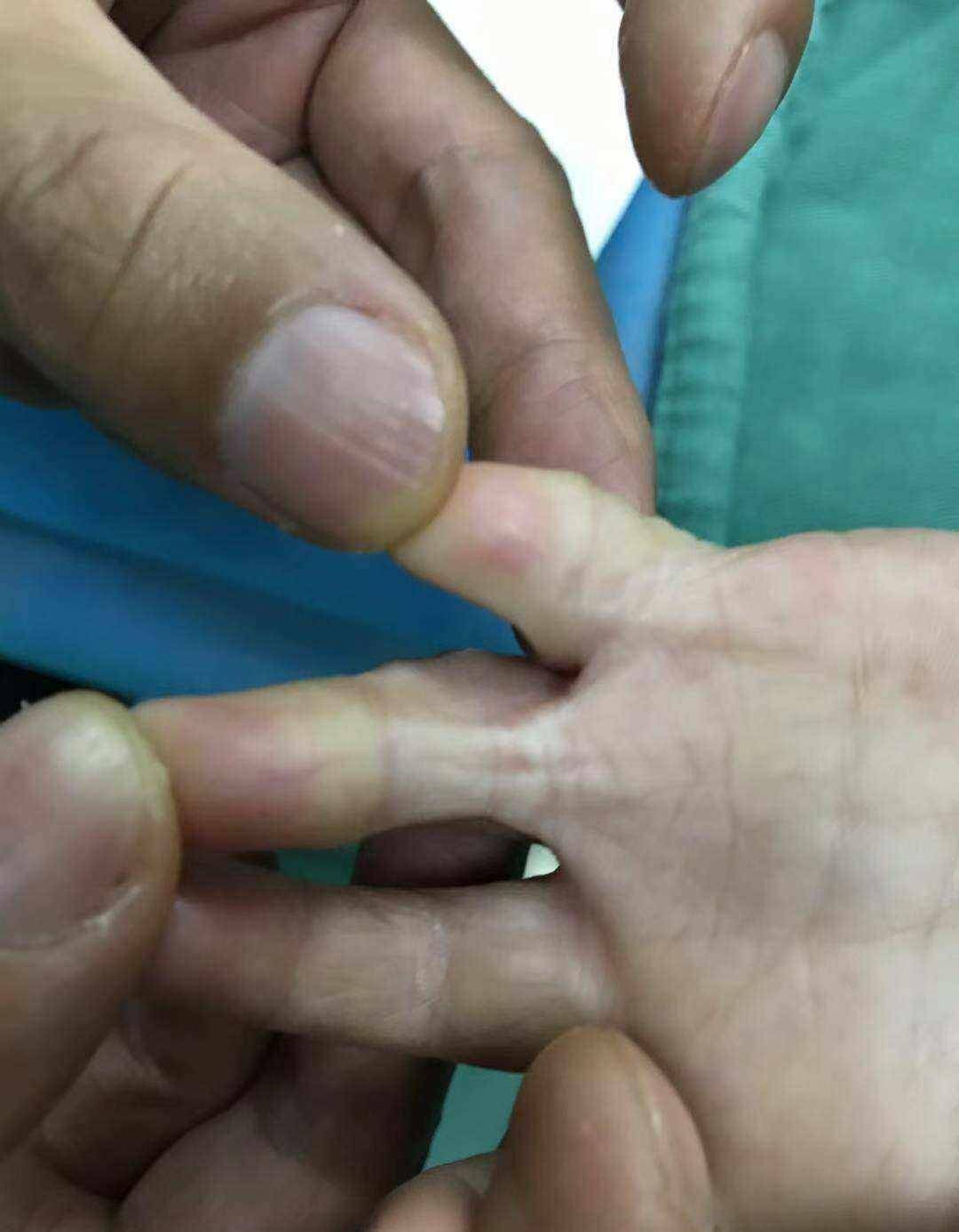 但由于早期手部高度肿胀,而又包扎过紧,导致骨间肌缺血挛缩,形成手背