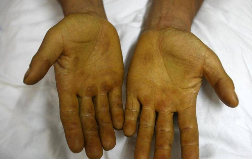 双手手掌两侧的大小鱼际线和手指尖处有粉红色的斑点或是斑块,受压后
