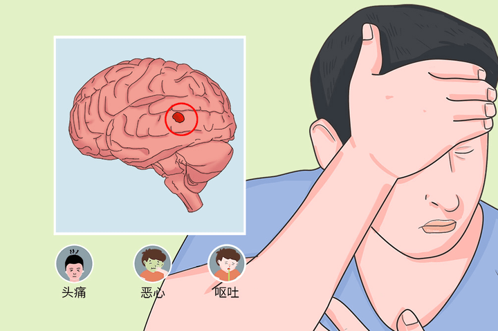 颅内肿瘤卡通图片图片