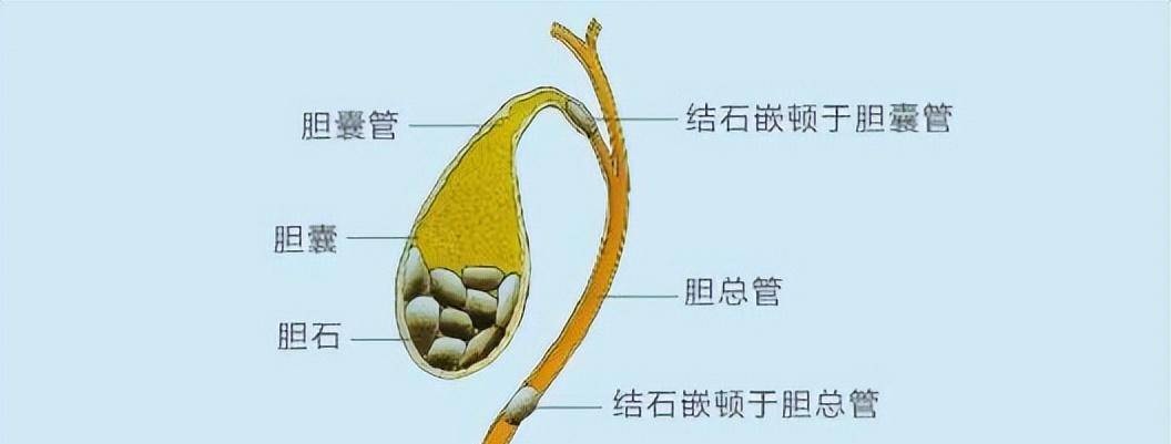 现役飞行员,飞行学员常见疾病:胆囊结石的鉴定_保胆_手术_治疗