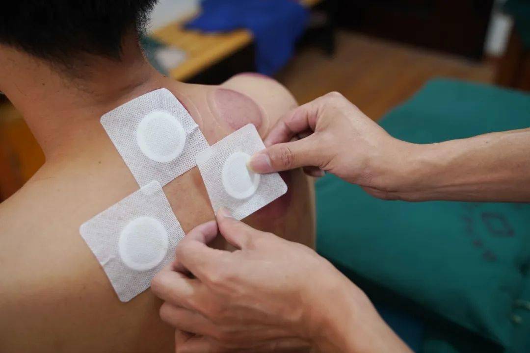 三伏天三伏贴的注意事项1,三伏贴贴敷时间宜在晴天上午,一般成人贴敷6