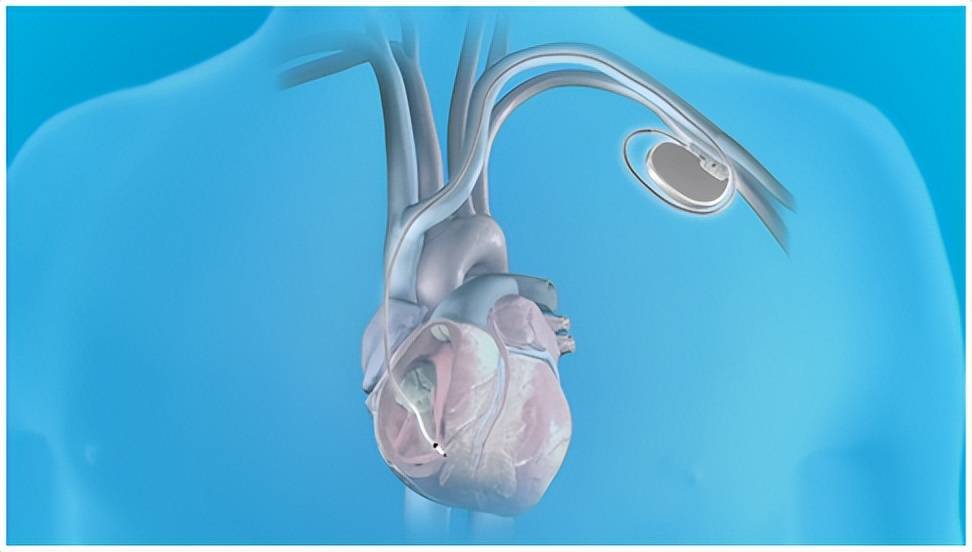 固镇县人民医院首台 全球体积最小micra av双腔无导线起搏器植入术