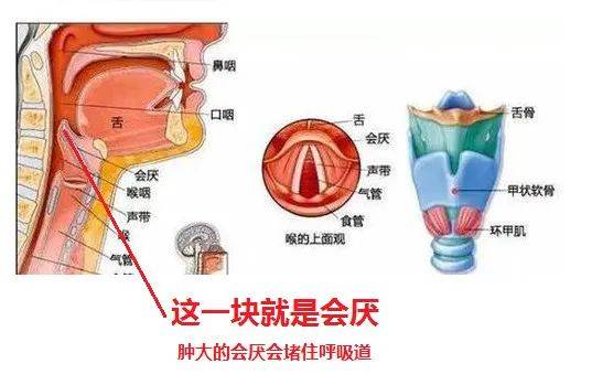 姑娘嗓子疼从就诊到去世仅10分钟! 急性会厌炎,你了解多少?_症状_治疗_气道
