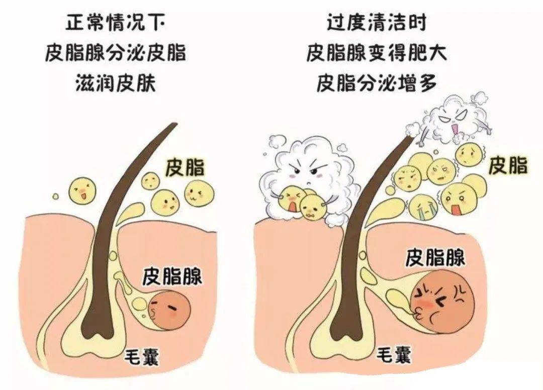 殊不知这样的过度去油行为,只会让皮脂腺以为前线失防,然后疯狂分泌