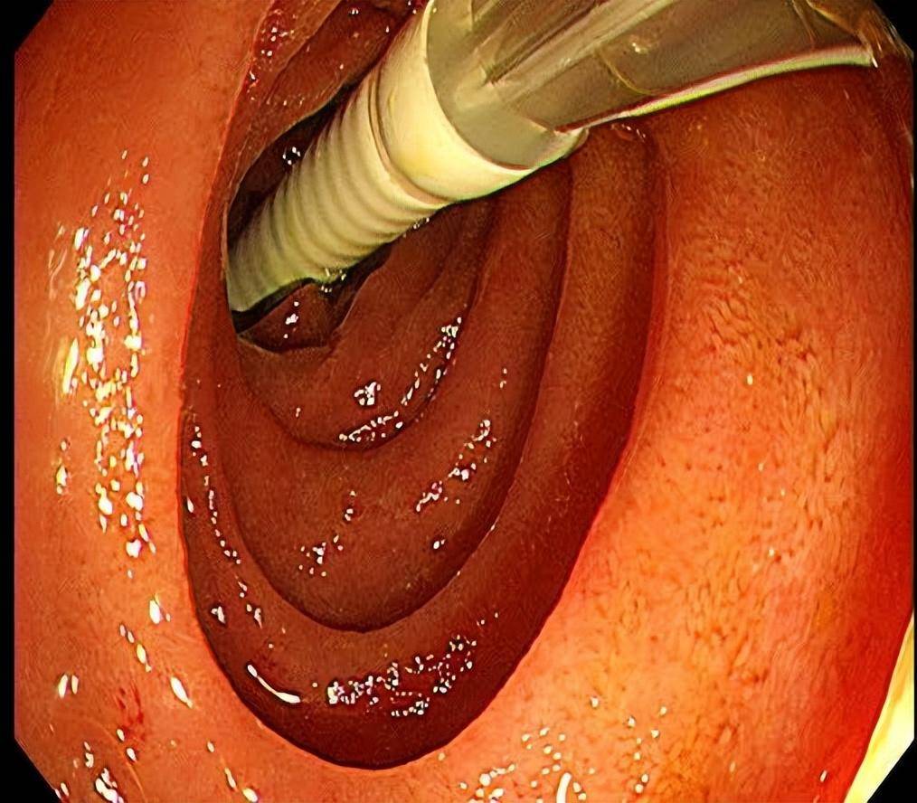 经肛型肠梗阻导管图片