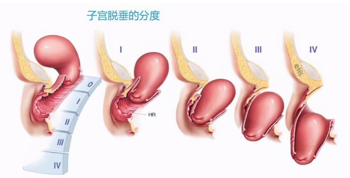 阴道口摸到肉肉