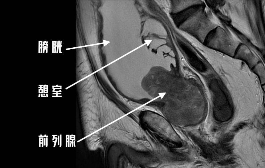 前列腺磁共振正常图像图片