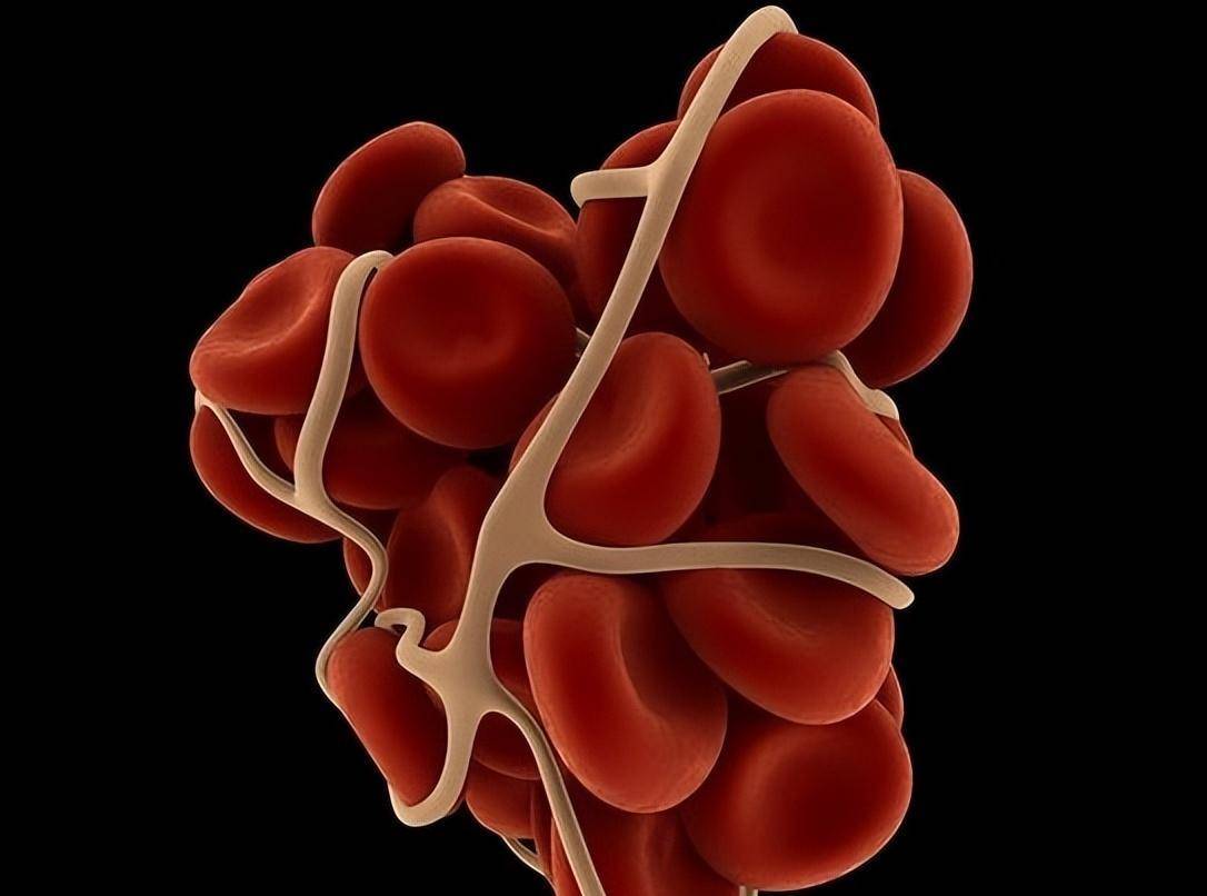 近年来血小板-白细胞在地贫患者中的作用也逐渐有报道.