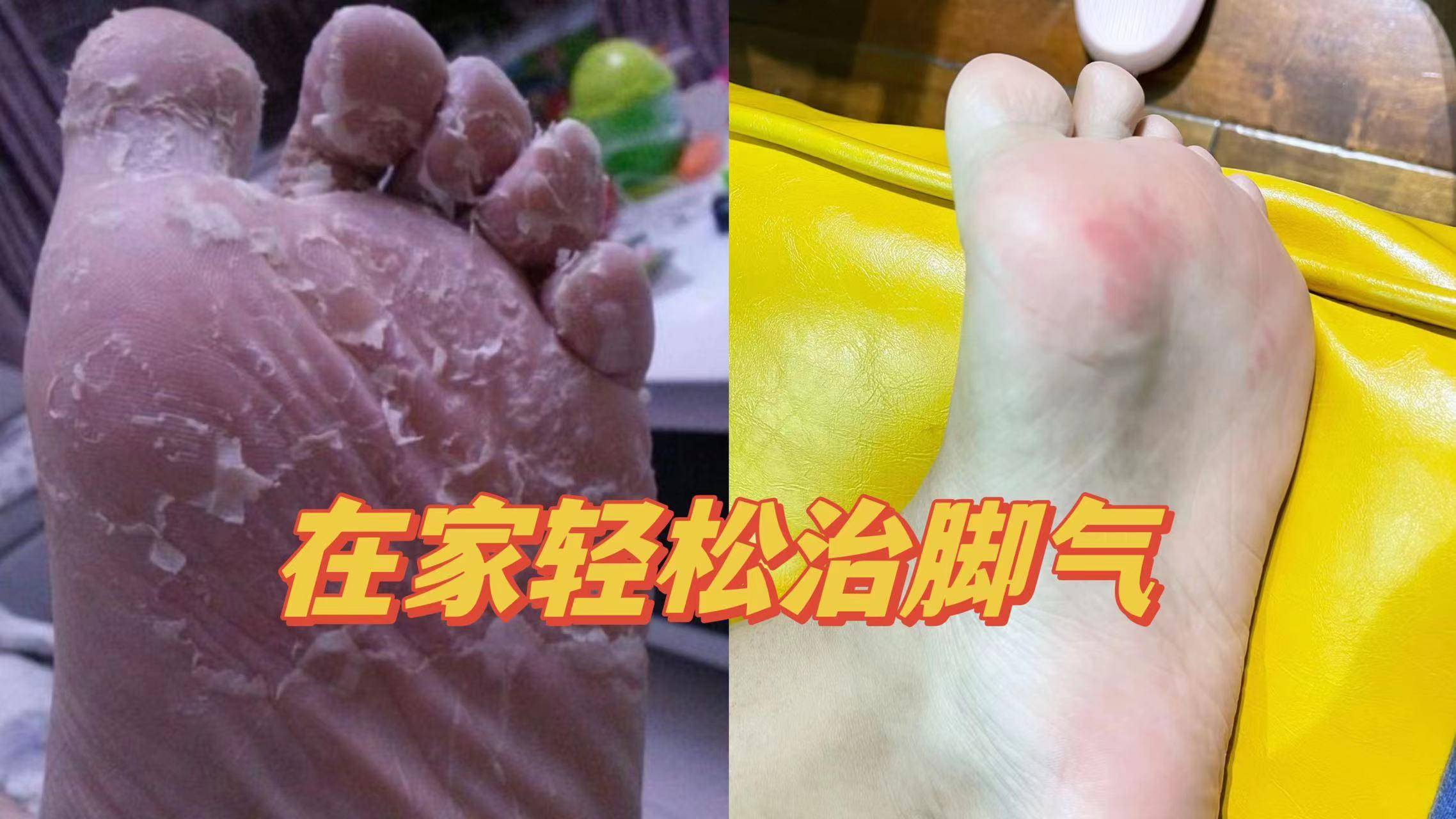 根治腳氣除真菌!這四個方法學會一個,雙腳馬上舒爽沒異味!