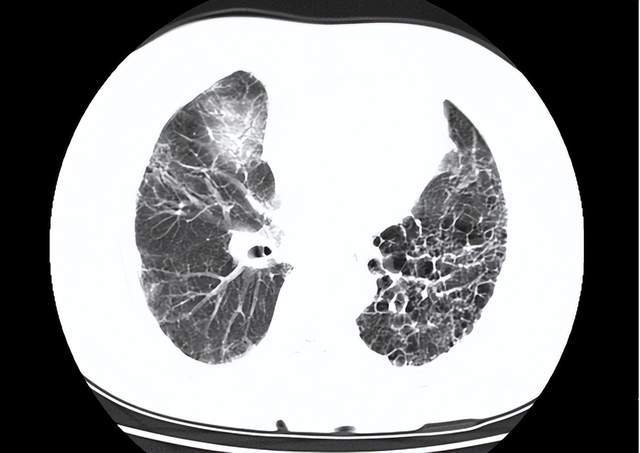 新冠后肺纤维化要命吗?不要错过肺康复的时机