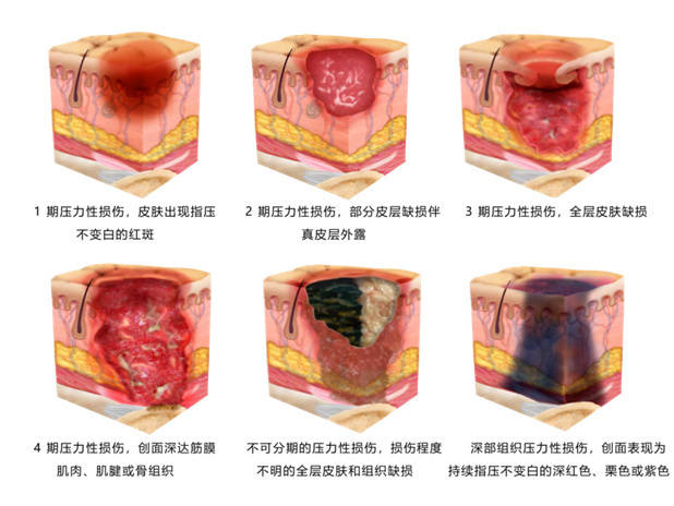 伤口愈合分期4个阶段图片