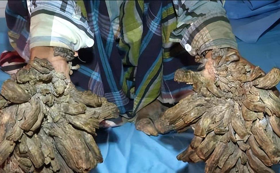 湖南农民患怪病30年,手脚长满树枝还开臭花!