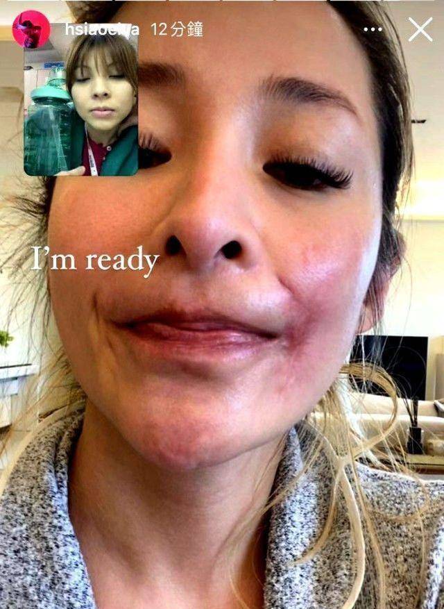 萧亚轩发脸部疤痕照,被爱犬咬伤后的恢复情况,并不理想_状态_伤痕