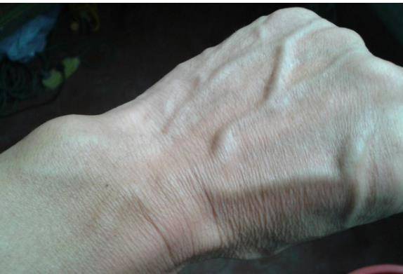 这个时分需求警惕能否存在着心脑血管畸形,一定要及早就医,中止心脑