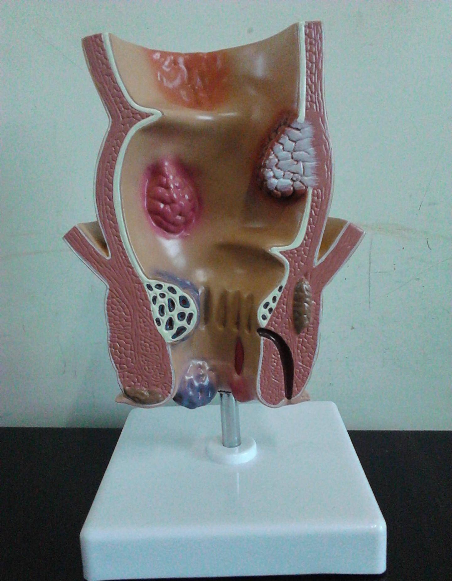 肛管直肠脱出时间过长会因直肠黏膜嵌顿而引起肿痛,糜烂,出血,坏死