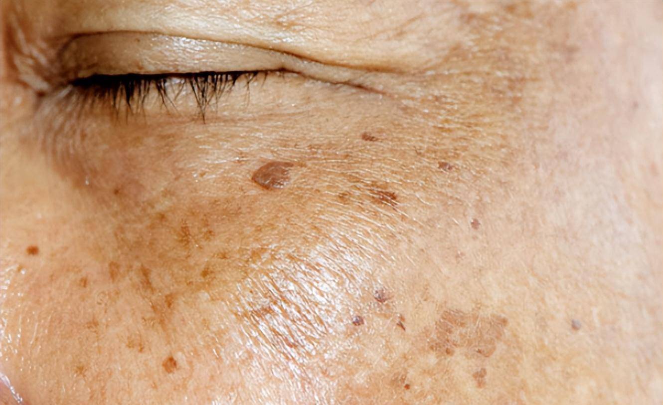 为什么有些人满脸"老年斑",有的却干干净净呢?