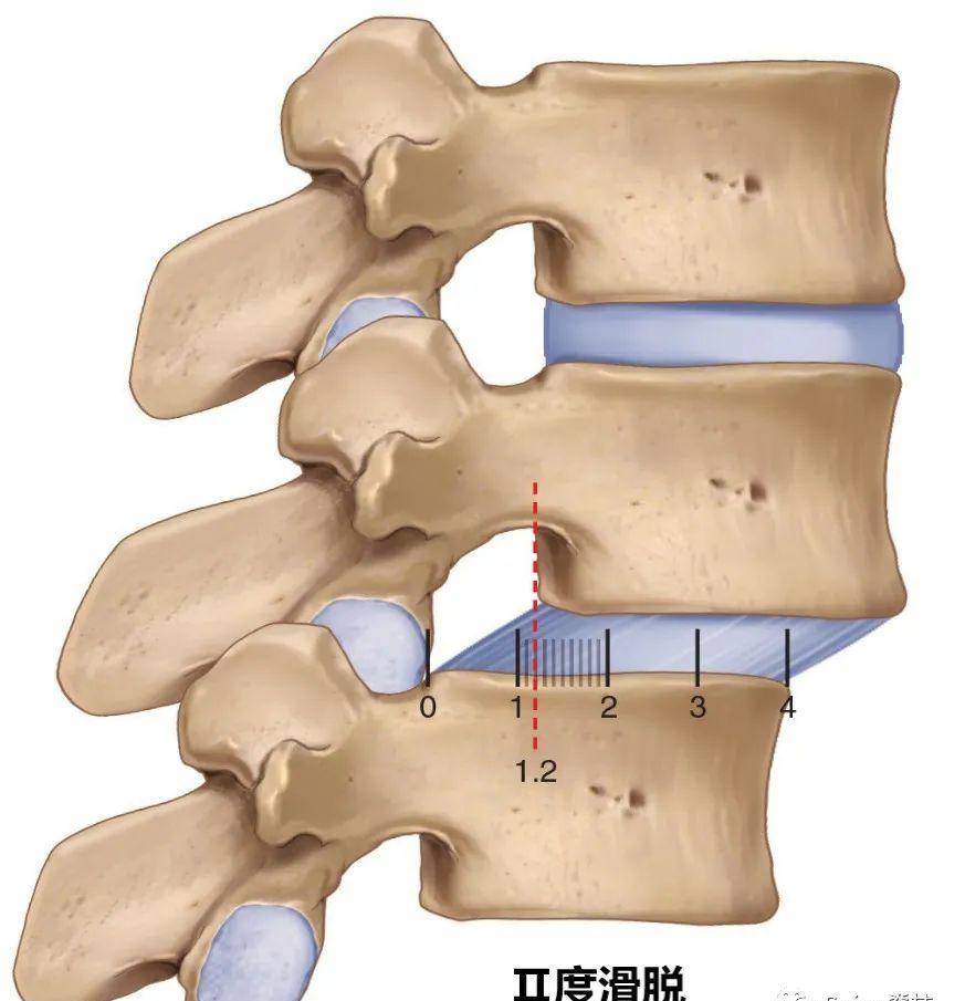 腰椎滑脱分级图片