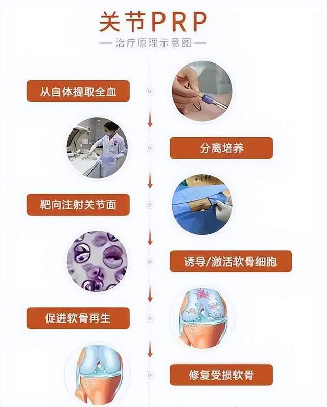 关节PRP再生修复治疗技术,为痛风类风湿患者带来康复希望_血小板_组织细胞_软骨