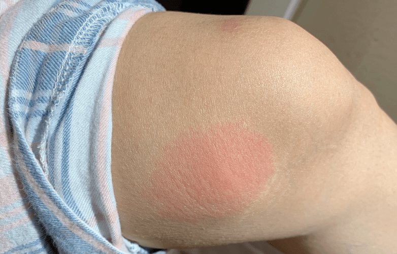 被肿腿蜂咬了怎么办呢?_皮肤_外用_药物