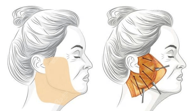 筋膜悬吊面部提升术怎么做?_皮肤_效果_切口