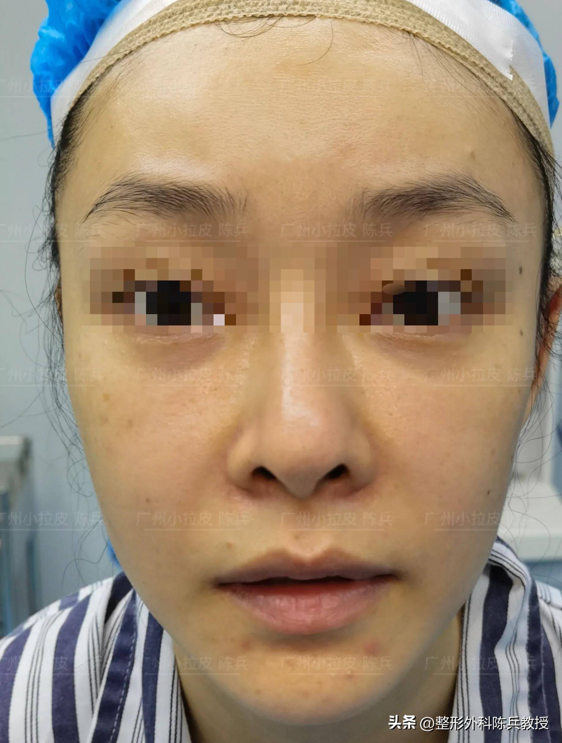 39岁做过脂肪填充和线雕,吸收后效果全无,变得空荡无弹性_时间_非手术