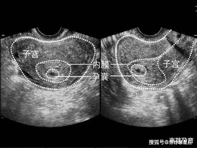 一孕囊双胞胎 b超图片图片
