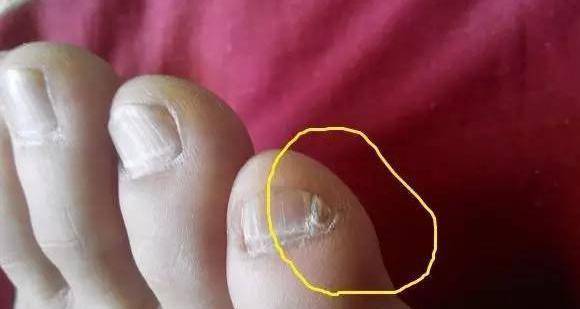 为什么很多中国人的小脚趾是两半的,是基因缺陷吗_朱元璋_剪指甲_汉人