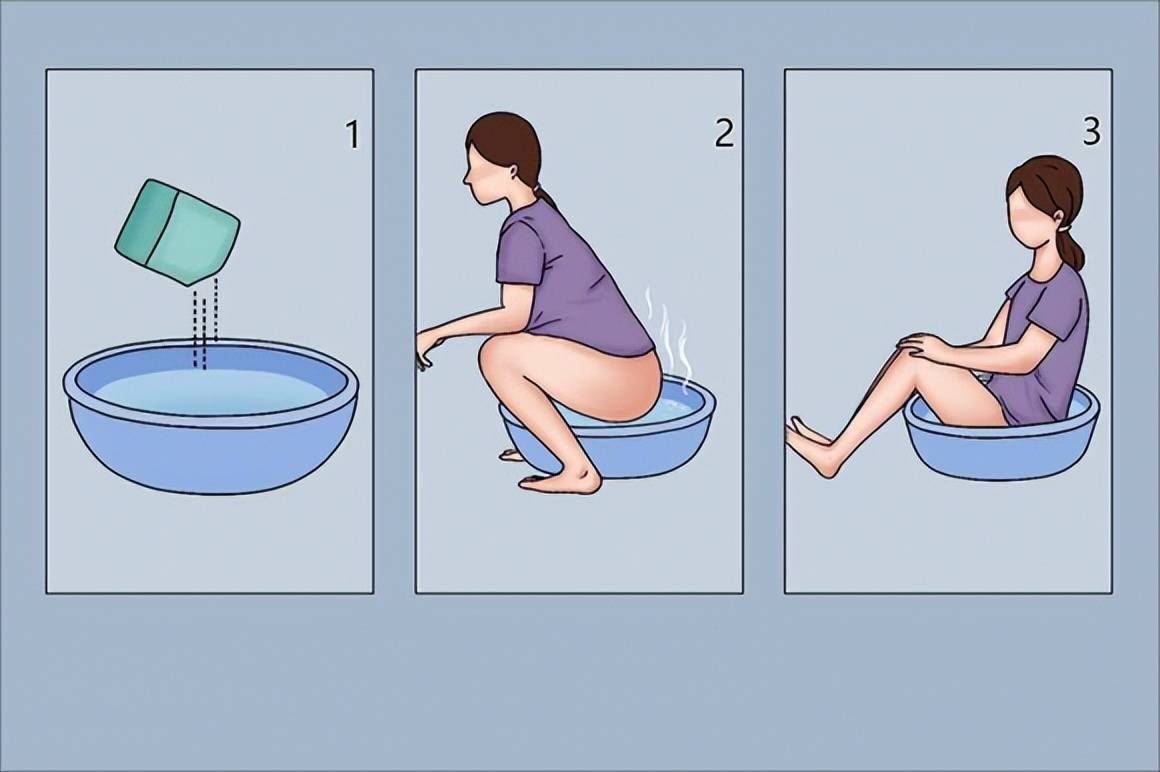 肛裂坐浴的正确方法图图片