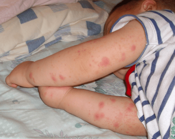 别不信!教你个"小窍门",螨虫跑光