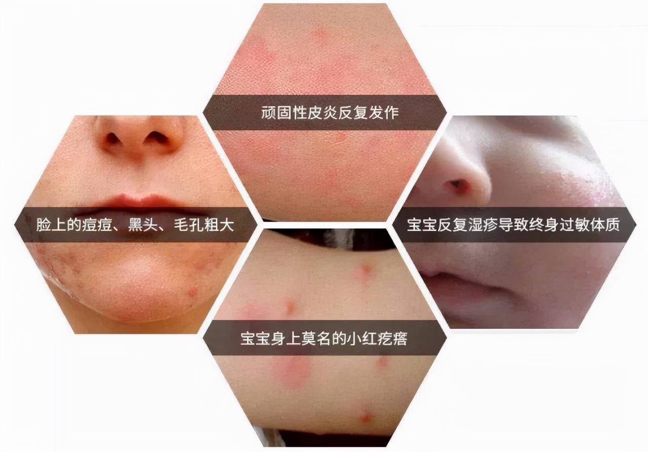 螨虫的最大"天敌"根本不是暴晒,教你个土法子,螨虫"全消失"_宝宝_问题