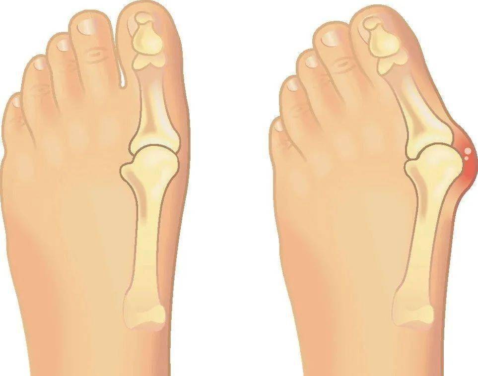 辽宁京城骨科医院拇外翻矫形中心助您恢复手部功能_治疗_方案_手指