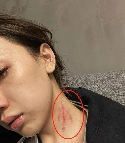 网红模特女子遭男友家暴流产,哭诉全身淤青,男友边吃软饭又劈腿_蔡瑛
