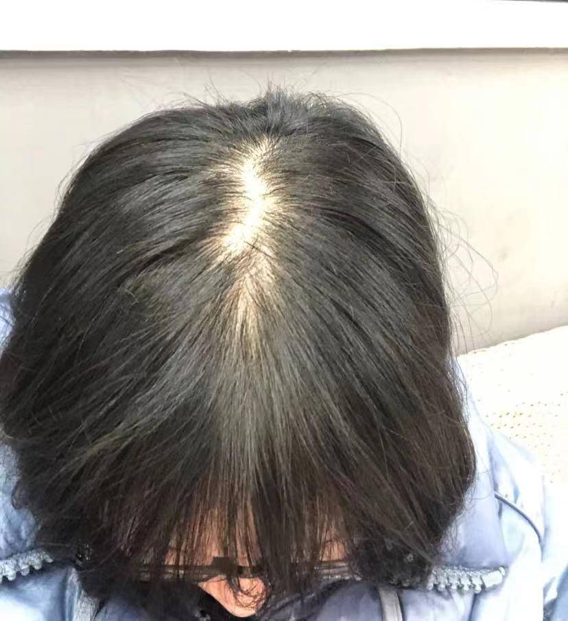 后来查了资料才知道是因为内分泌失调引起的.