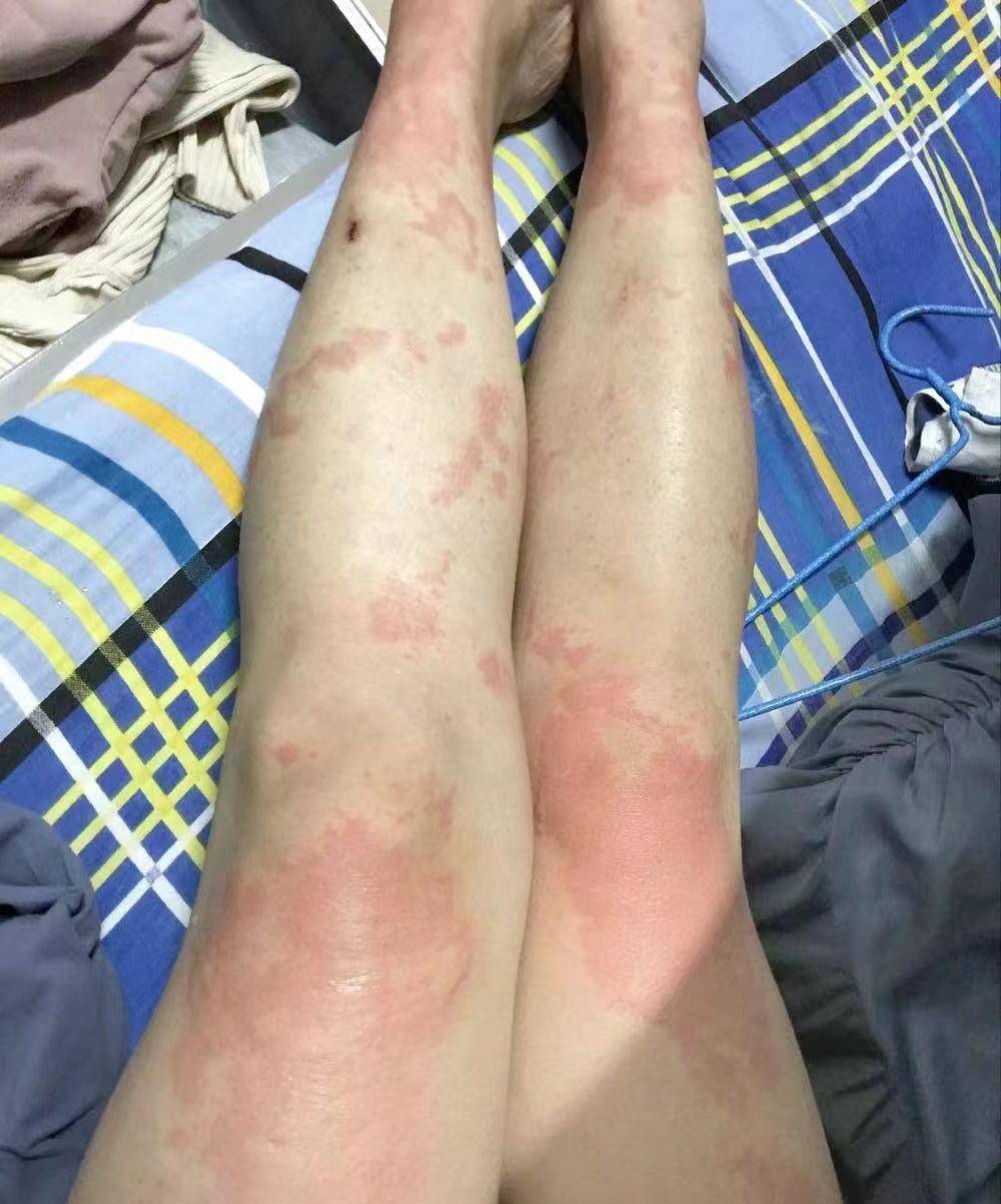 五年治疗经验分享,用过的网友都好了?_皮肤_维生素_辅助