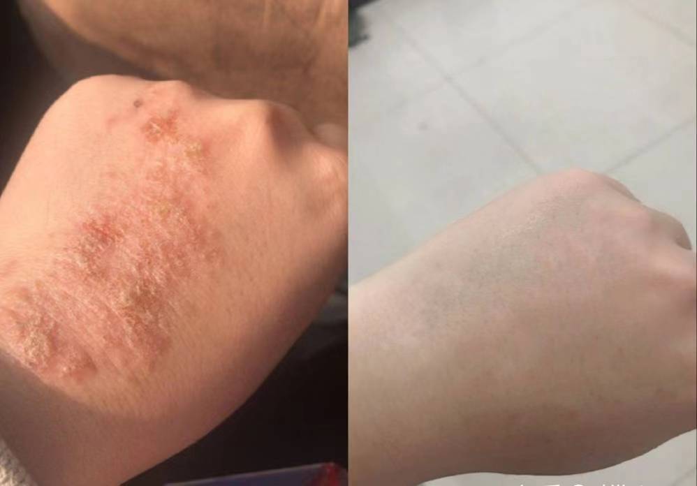 湿疹瘙痒没救了？过来人自用小妙招！皮肤快速止痒不反复插图6