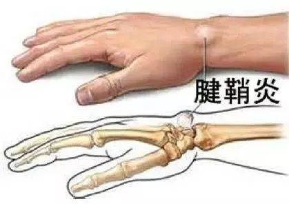 大拇指腱鞘炎怎么引起,这些问题一定要引起重视