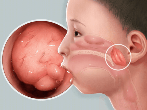 腺样体肥大会有哪些表现(孩子为什么会得腺样体肥大和如何治疗)