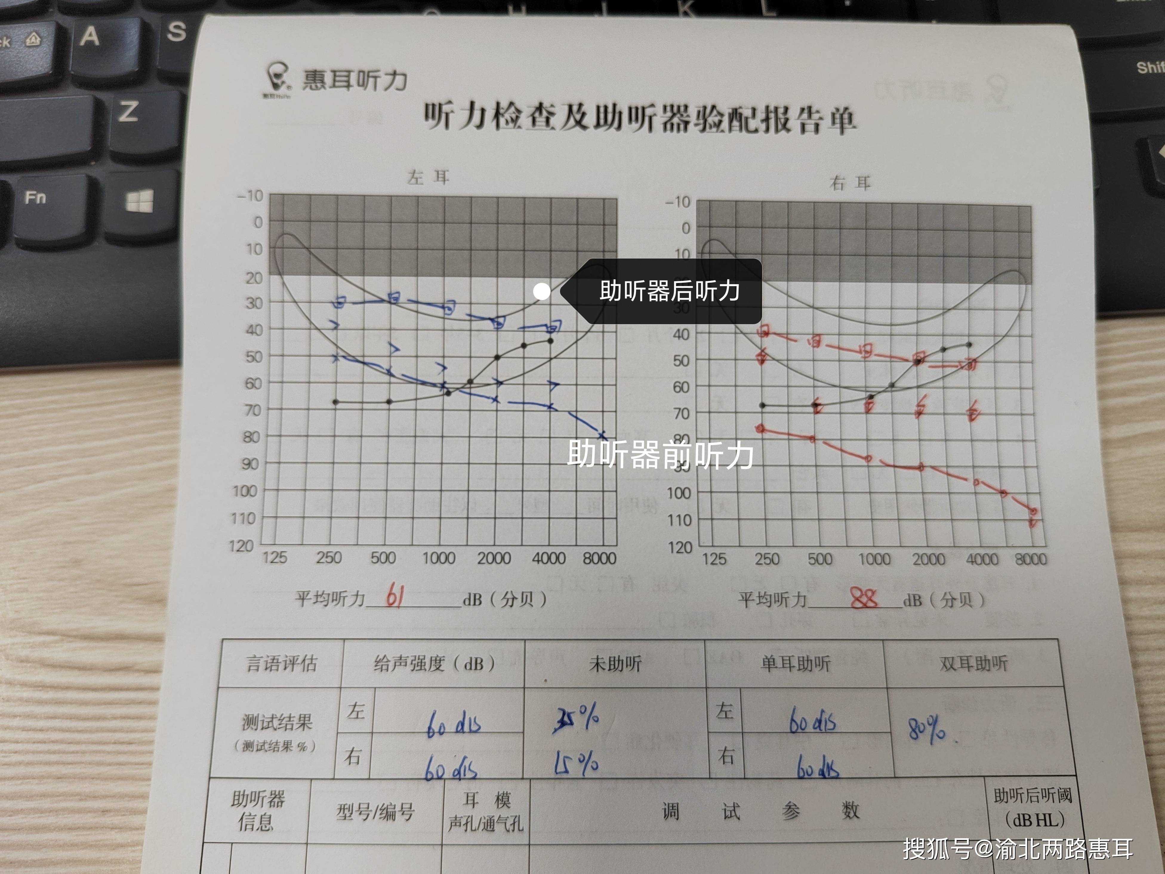 hl 属重度聋,语言分辨率:35%;电测听:四,听力检测结果:鼓膜正常,耳朵