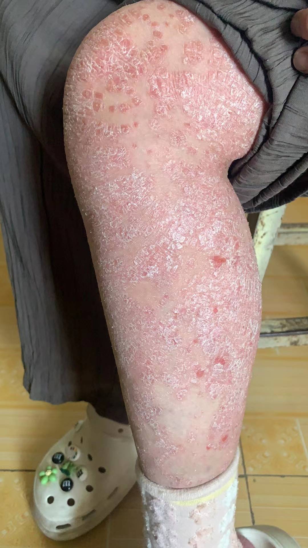 超度牛皮癣-牛皮癣好转的十大征兆