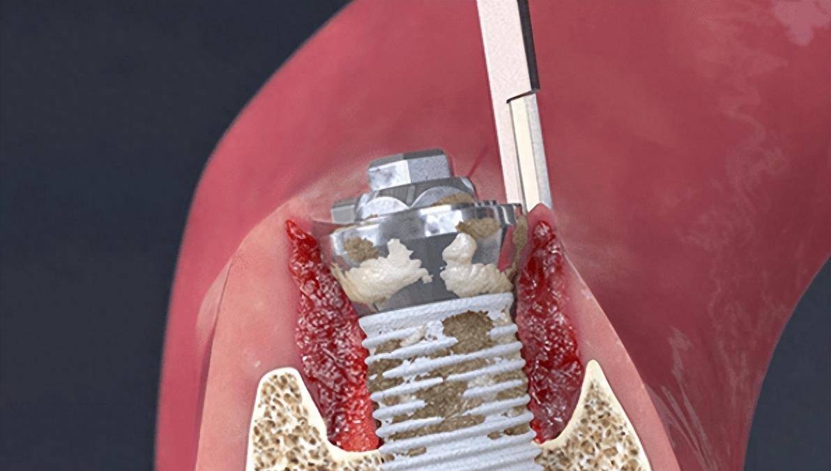 植骨材料在临床中的应用现状及进展_异体_诱导_磷酸钙