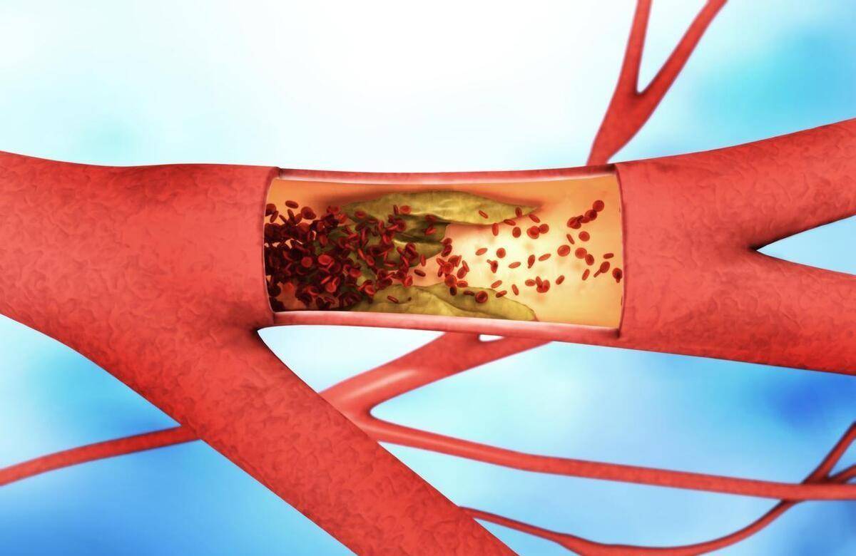 血管狭窄70%到50%,这位48岁患者说:做好这3点,血管狭窄可逆转_刘先生