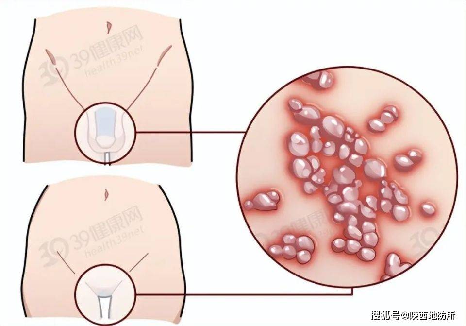 淋病脓性分泌物图片